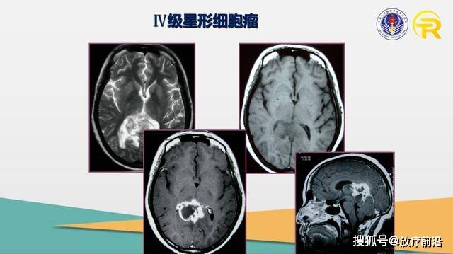胶质瘤最新治疗方法观点论述，探索最新治疗策略