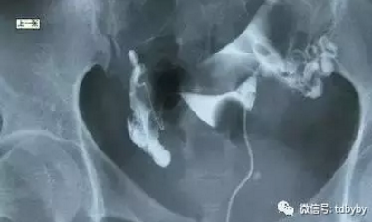 全面科普解答,输卵管造影价格及费用详解